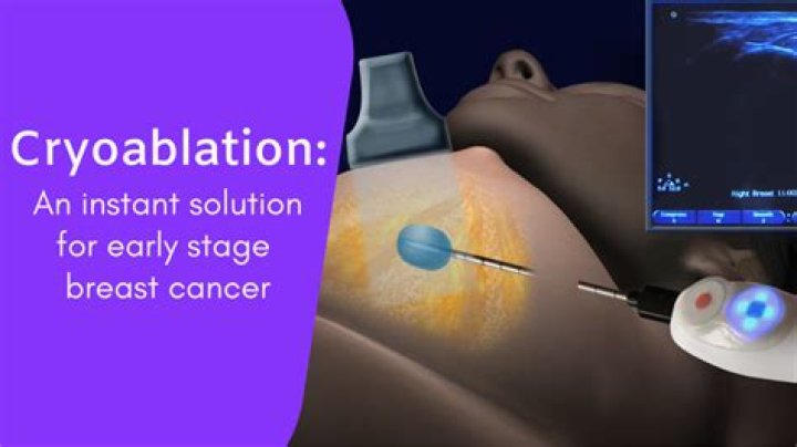 Cryoablation for the Breast Surgeon