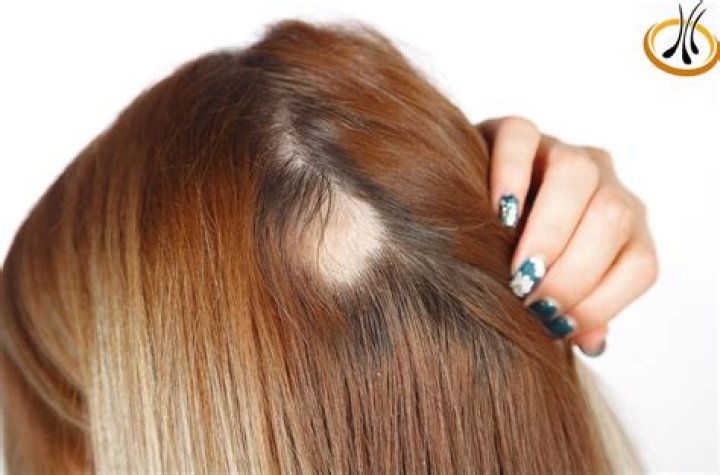 La relación entre el estrés y la alopecia